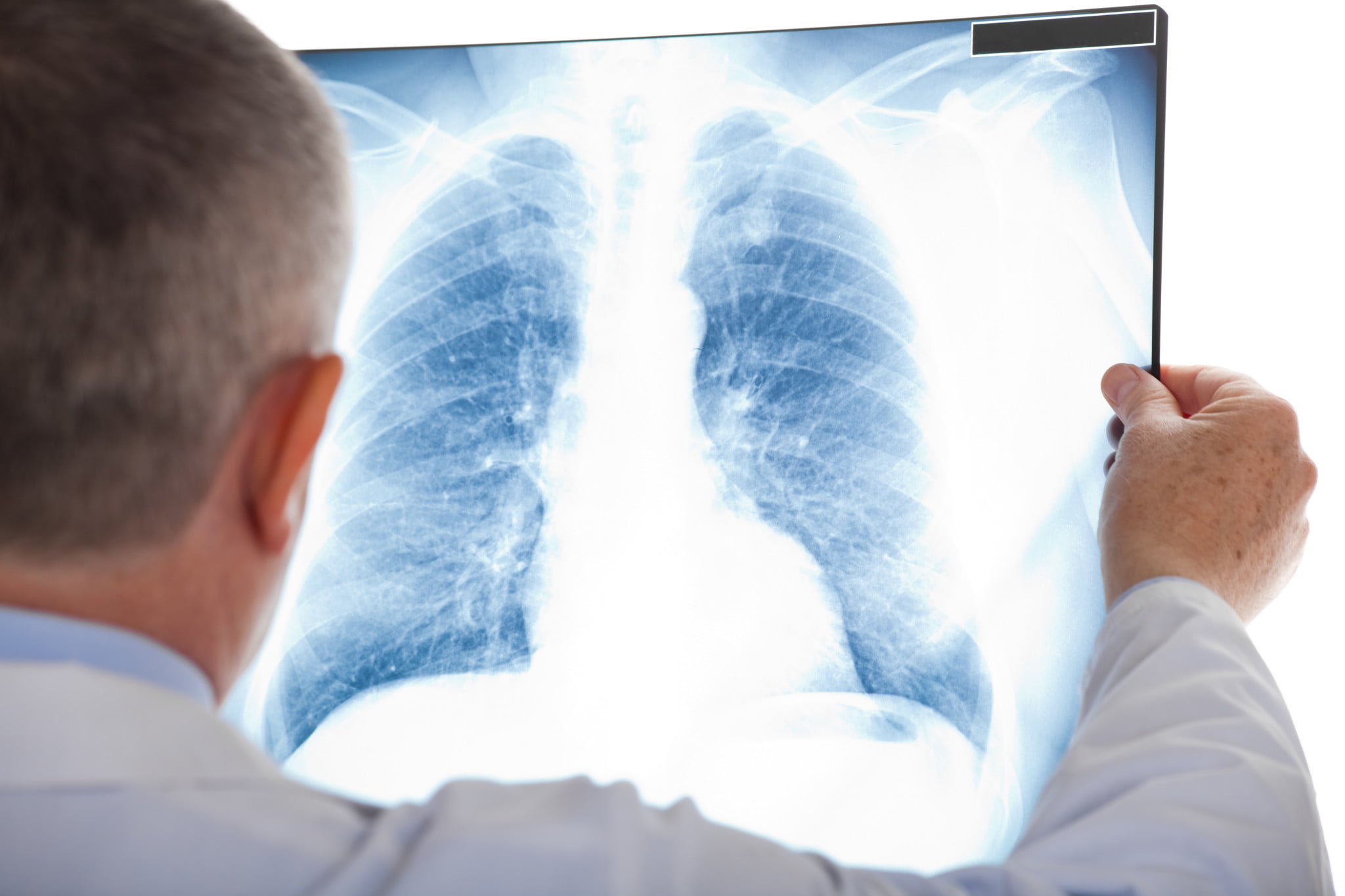 lung radiography, pneumonia awareness