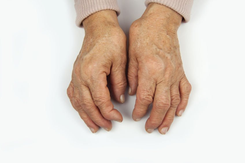 rheumatoid arthritis