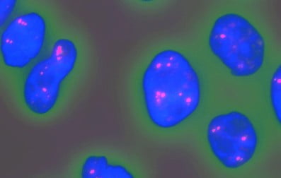 paraspeckles: Motor Neurone Disease
