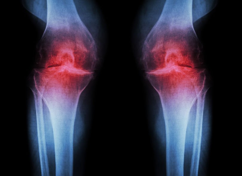 knee and back pain: arthritic knee x-ray