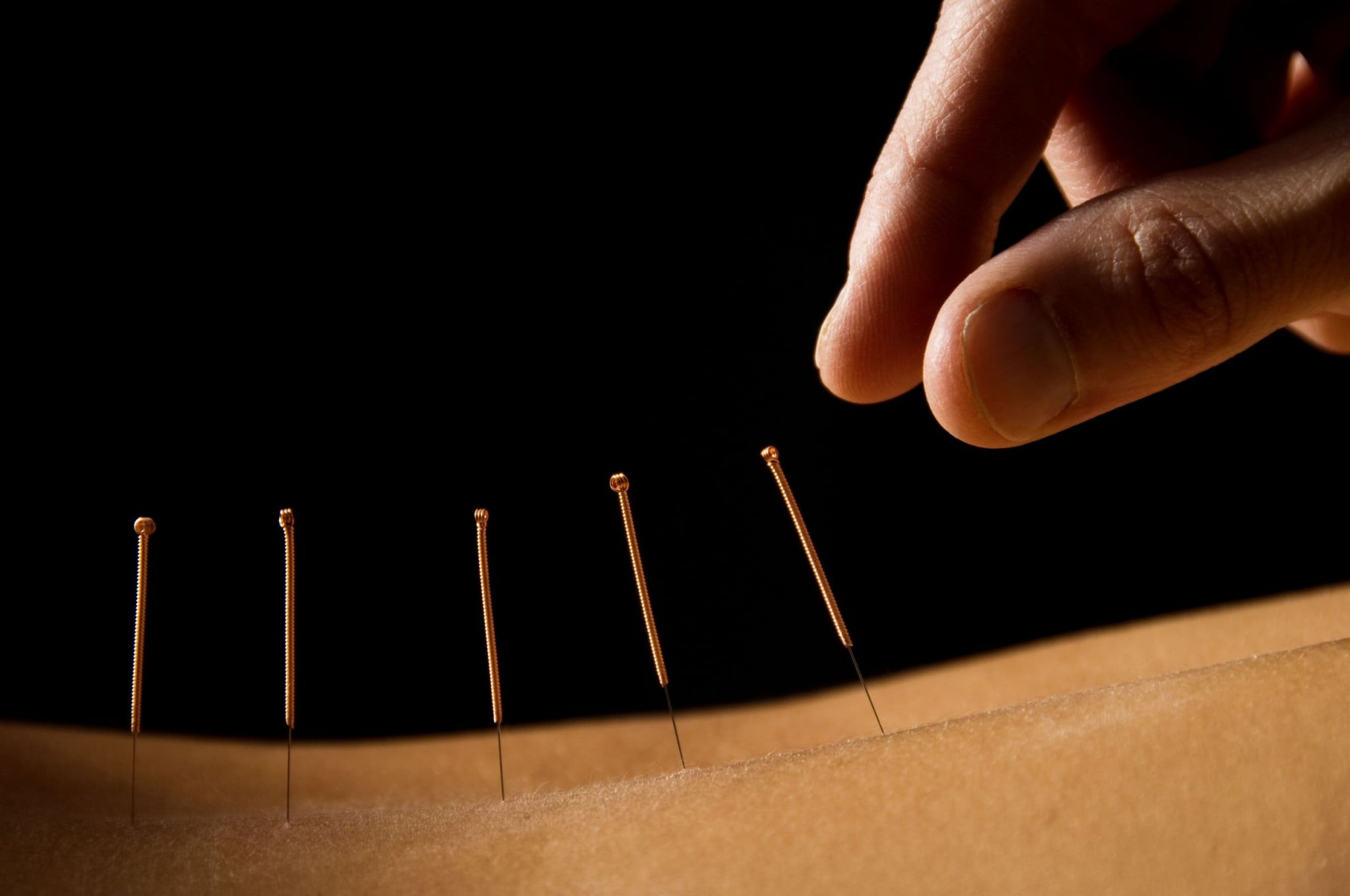 acupuncture needles in back