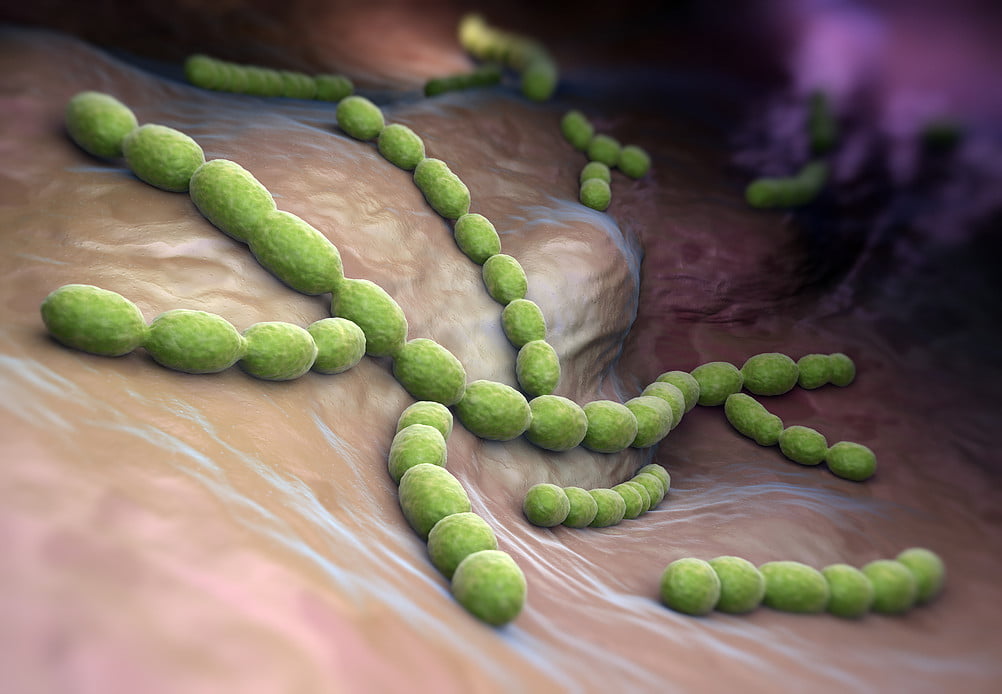 pneumococcal pneumonia