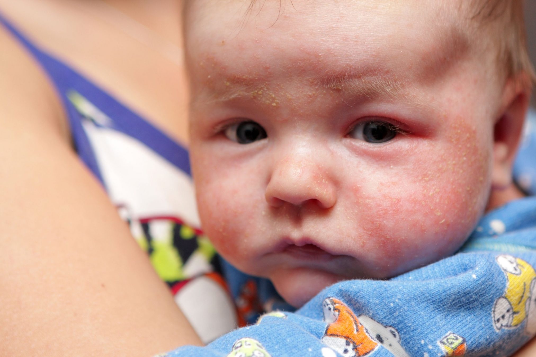 9651368 - this is eczema on face of newborn
