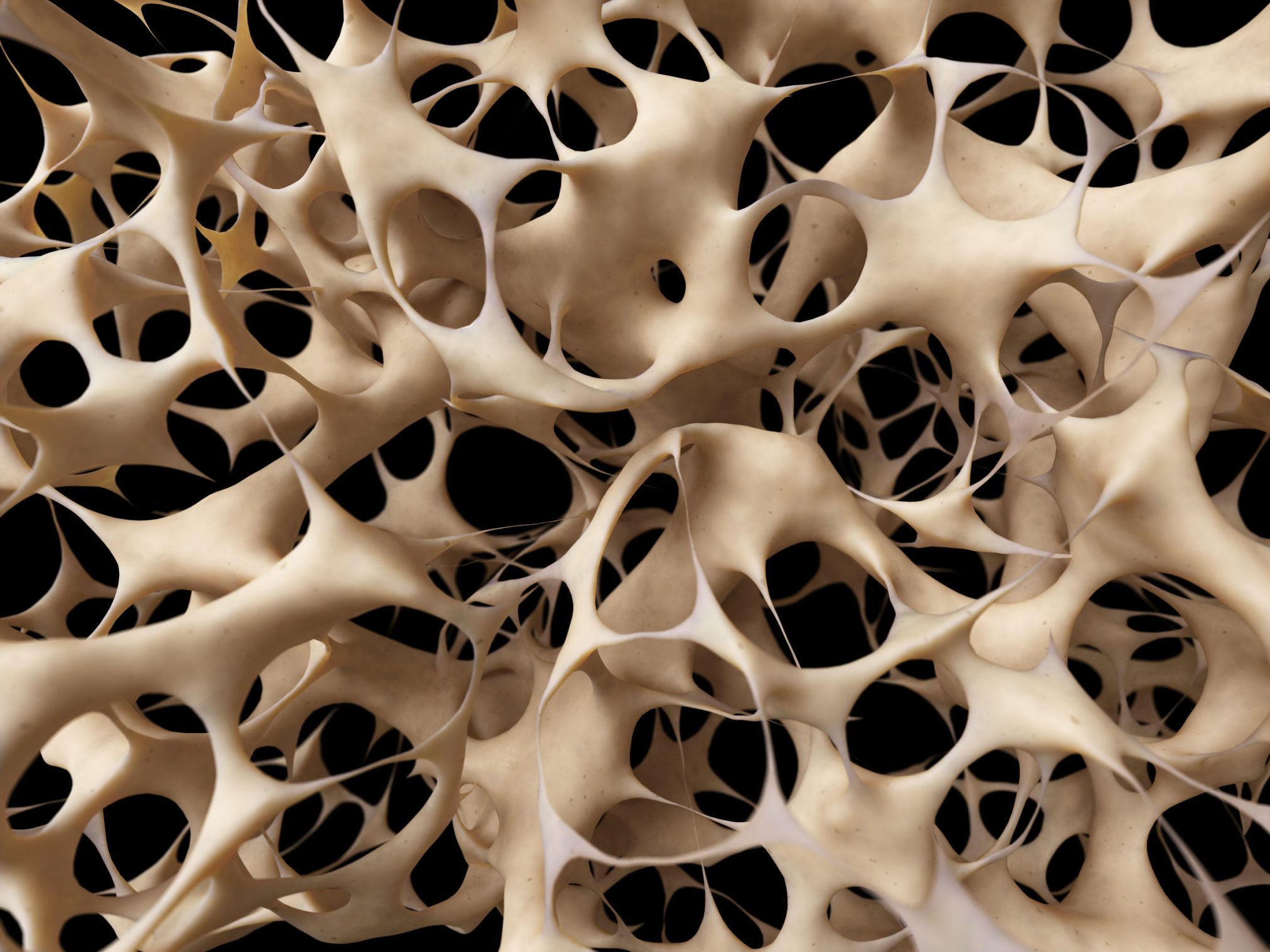 32387683 - osteoporosis - unhealthy bone structure