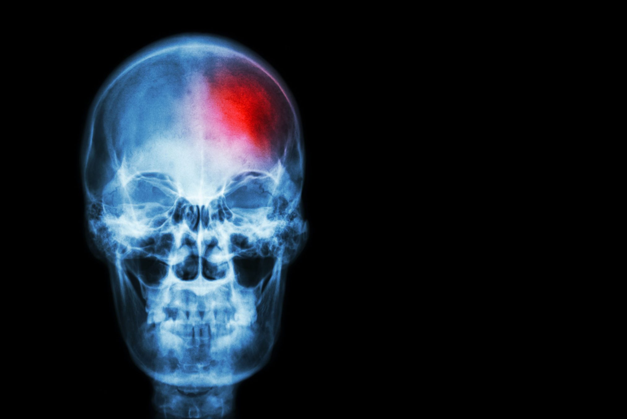 skull with large red spot