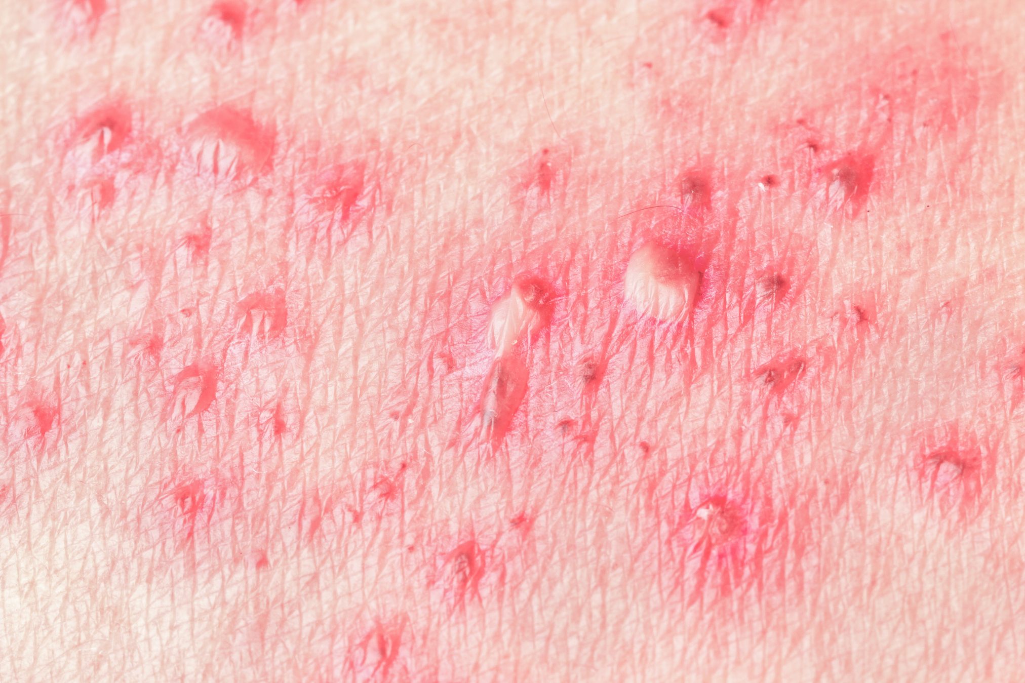 Shingles