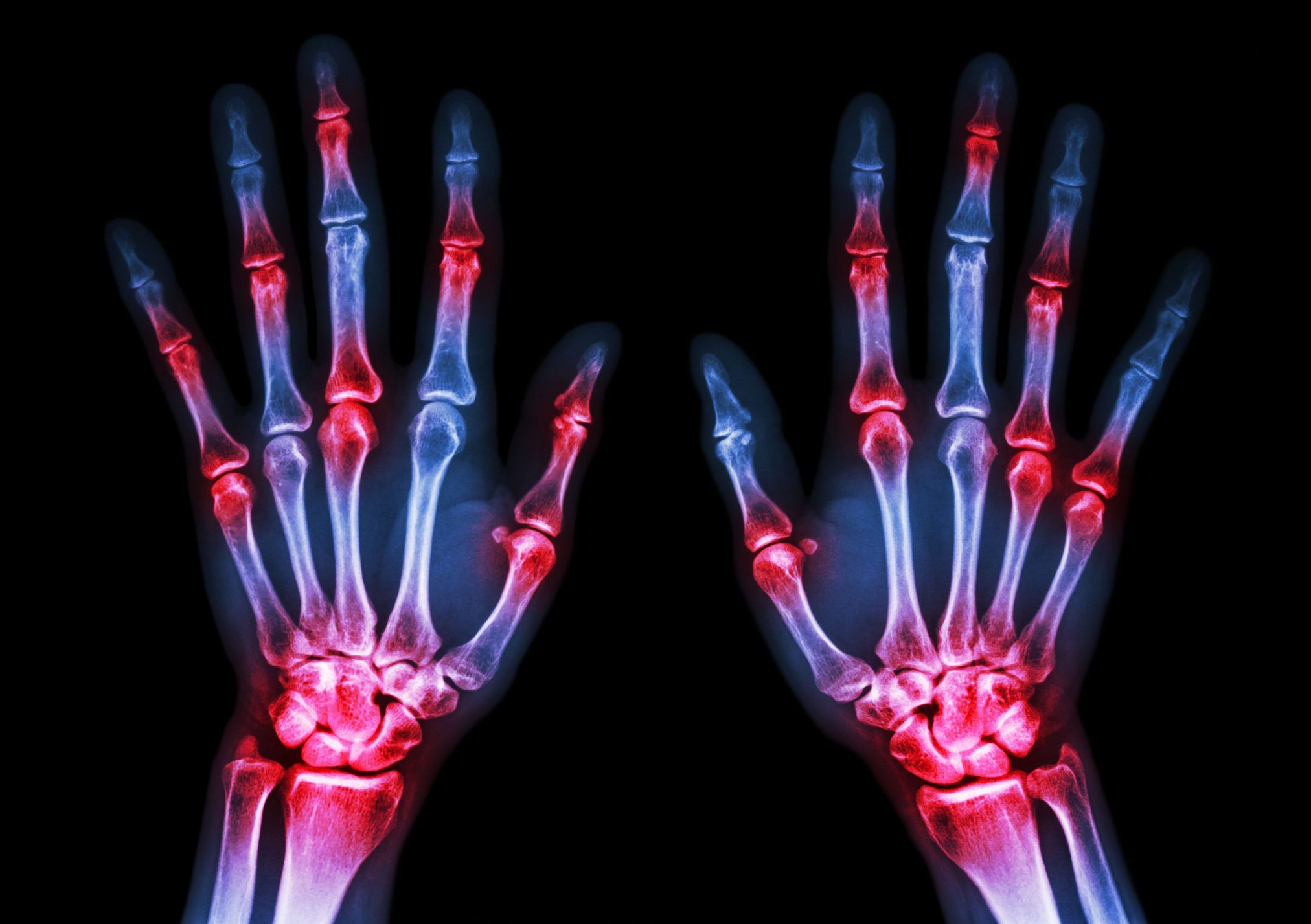 arthritis gout inflammation sore hands joints