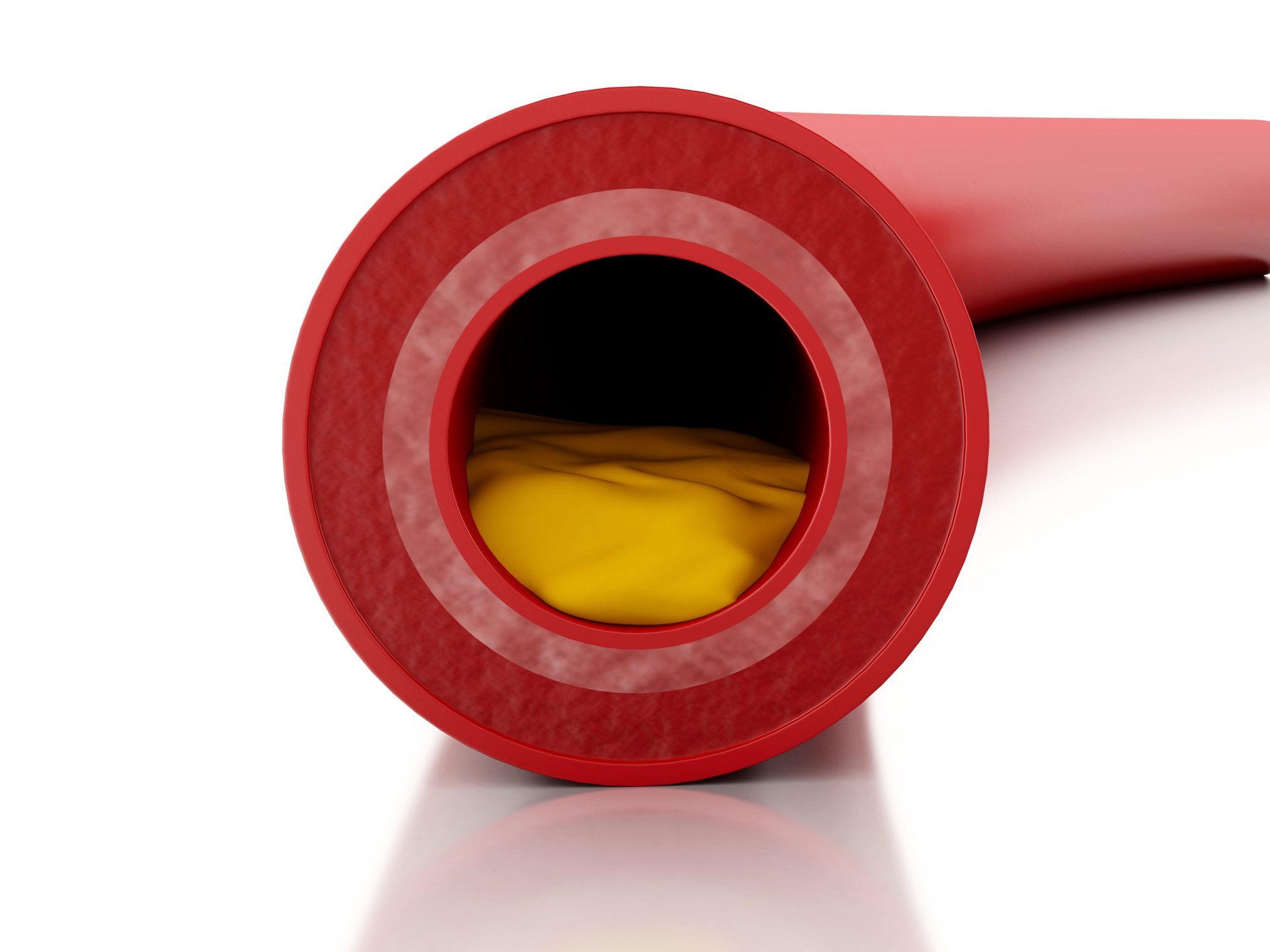 cholesterol in an artery