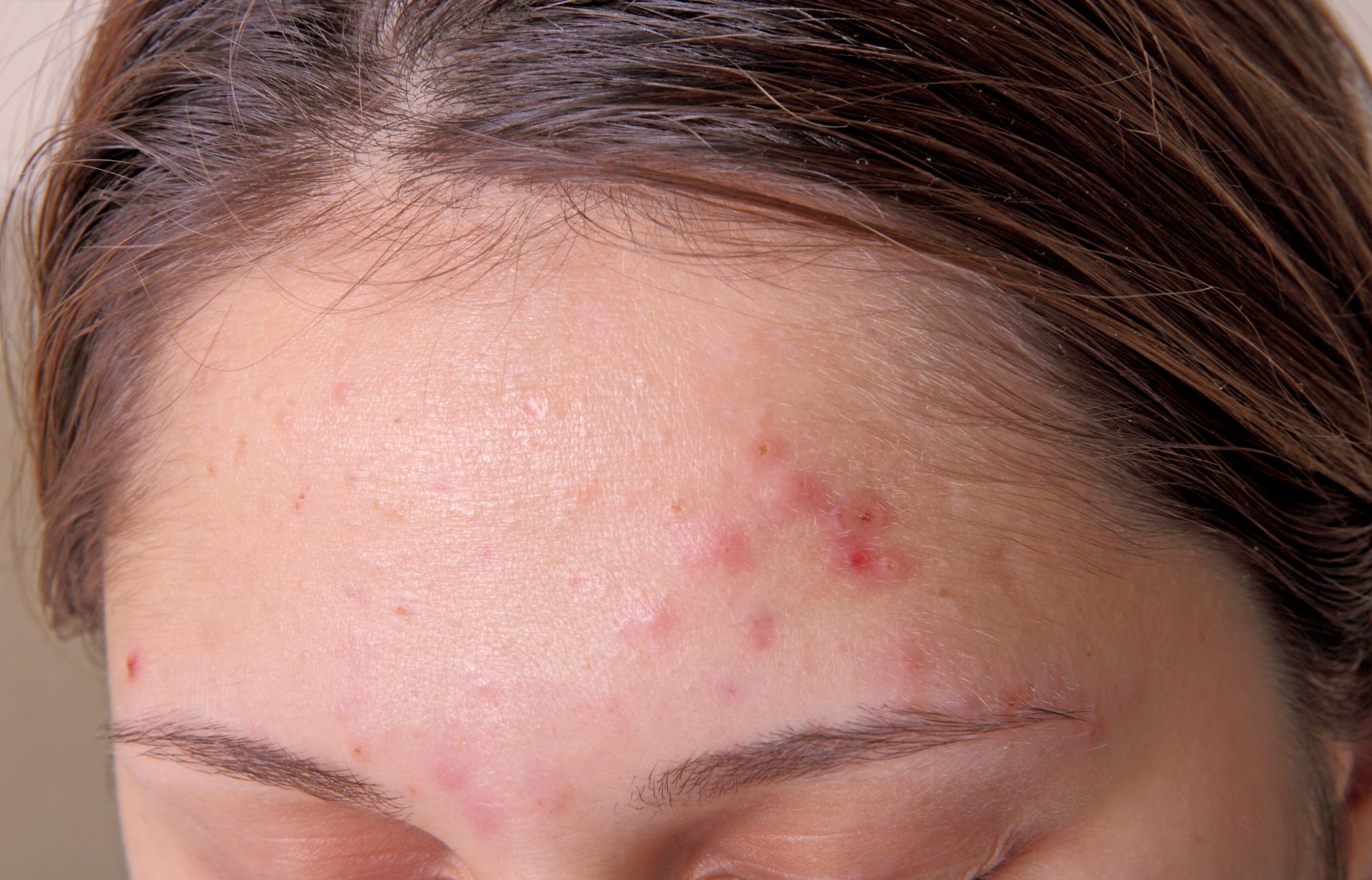 forehead with acne pimples